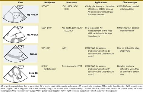 Aortic Stenosis: Etiology, Pathophysiology, and Clinical Presentation - OpenAnesthesia