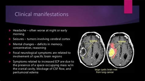 Adult CNS Tumors Neurology