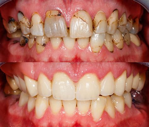 Composite Bonding London | Tooth Bonding from Just £595