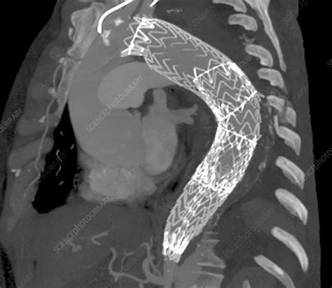 Stent to treat aortic aneurysm, CT scan - Stock Image - C009/5445 - Science Photo Library