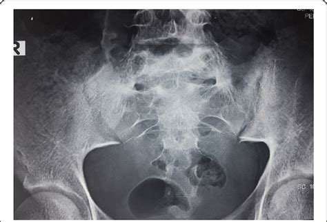 Sacroiliac Joint Arthritis