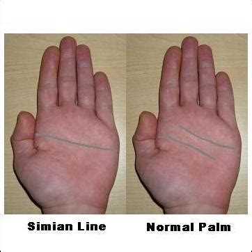 Turners Syndrome Hands Images & Pictures - Becuo