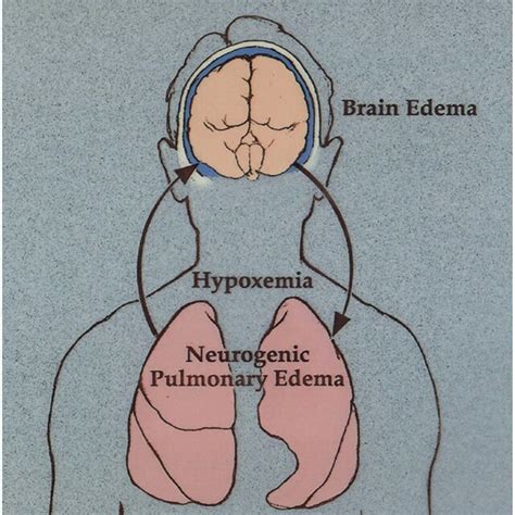 Neurogenic pulmonary edema as a manifestation of hyponatremic ...