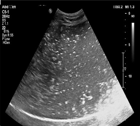 Abdominal Mass Ultrasound