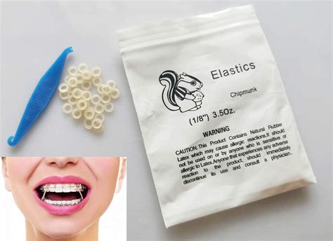 Elastics (orthodontics) | ubicaciondepersonas.cdmx.gob.mx