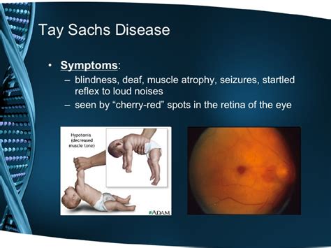 Tay- Sachs disease