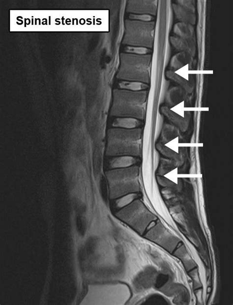 Spinal Stenosis: Treatment & Relief | Aptiva Health