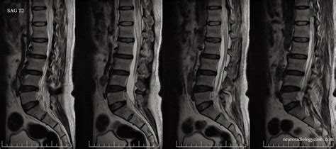 Cervical Myelomalacia treatment