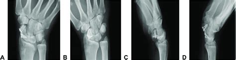 Postoperative x-rays. A Radial deviation. B Ulnar deviation. C Flexion.... | Download Scientific ...