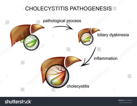 Illustration Gallbladder Inflammation Pathogenesis Disease Stock Vector ...