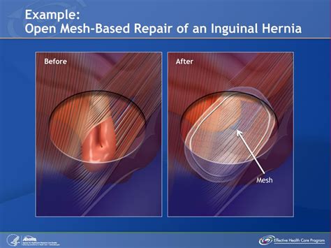 Hernia Mesh Types