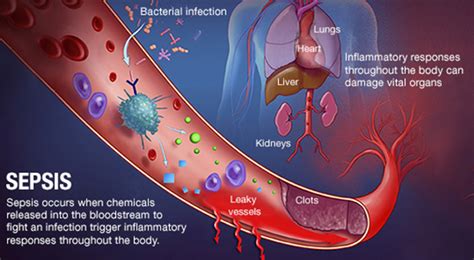 Sepsis | Top Neuro Docs