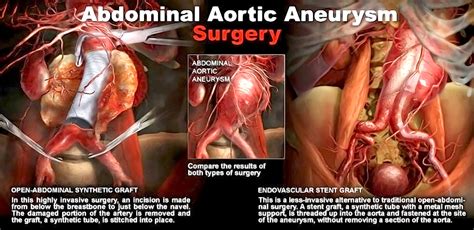 Treatment of Aortic Aneurysm - StoryMD