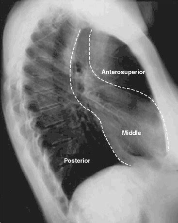 Masses of the Middle Mediastinum | Thoracic Key