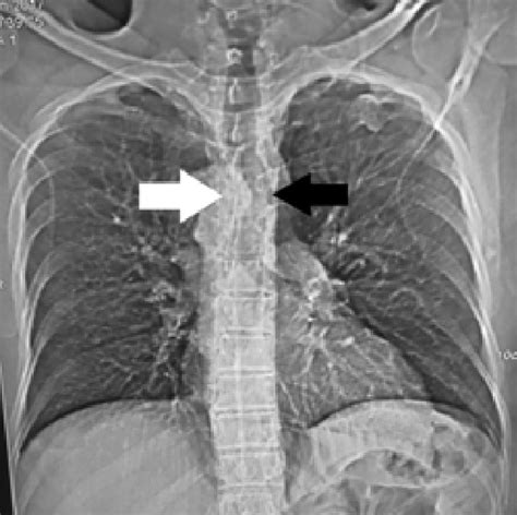 Plain X-ray chest PA view. The aortic knuckle is seen on right side ...