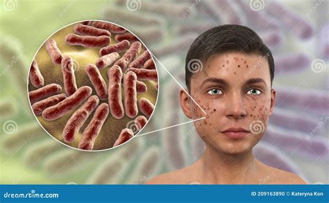 Acne Vulgaris and Bacteria Cutibacterium Acnes Stock Illustration ...