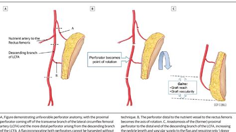 [PDF] Auto flow-through technique for anterolateral thigh flaps. | Semantic Scholar