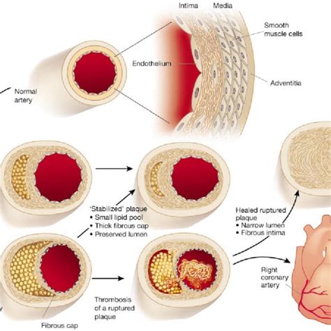 1: A depiction of the progression of atherosclerosis, showing the... | Download Scientific Diagram