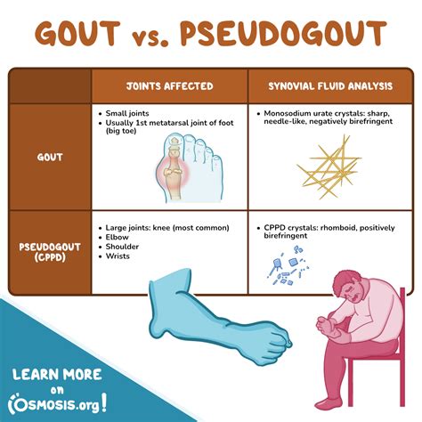 Gout Vs Pseudogout Crystals