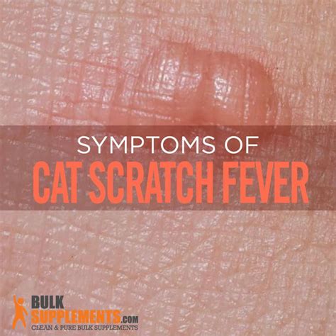 Cat Scratch Fever: Characteristics, Causes & Treatment