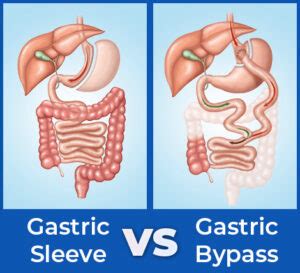 Gastric Sleeve vs Gastric Bypass: Pros & Cons | BMI of Texas