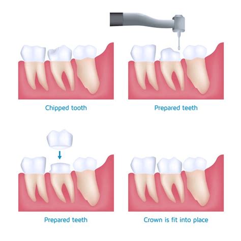 Dental Crowns in Manchester | The Vallance Dental Centre