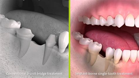 Straumann - Conventional 3-unit bridge treatment & implant-borne single-tooth treatment - Dental ...