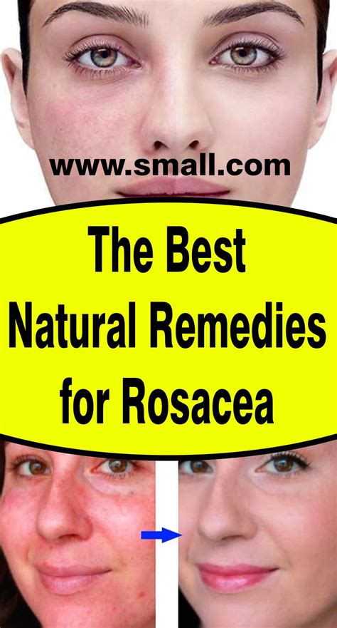 The Best Natural Remedies for Rosacea | Natural remedies for rosacea, Natural remedies, Health ...