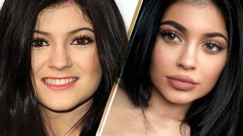 Kylie Jenner Lip Fillers Plastic Surgery Before and After Photos ...