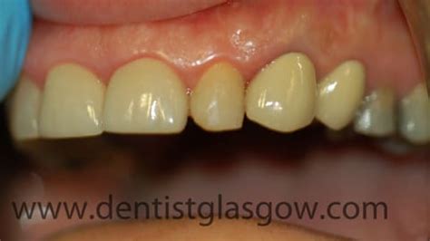 Dental Implants and Porcelain Bonded Crown | Glasgow Case Study