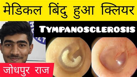 कान का मेडिकल बिंदु हुआ क्लियर 👂 #tympanosclerosis 👂 #Ashokbest jaipur ...