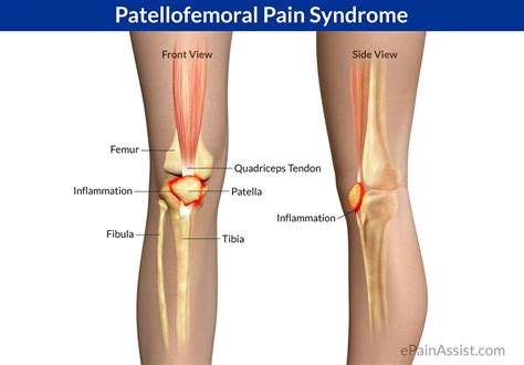 Patellofemoral-Pain-Syndrome - Podiatry HQ