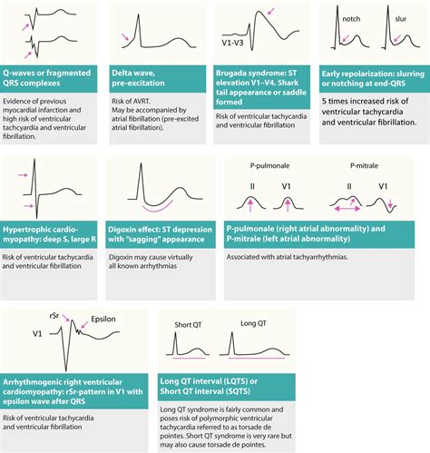 Figure 3. Changes on resting ECG that may reveal cause of arrhythmias (arrhythmia substrates ...