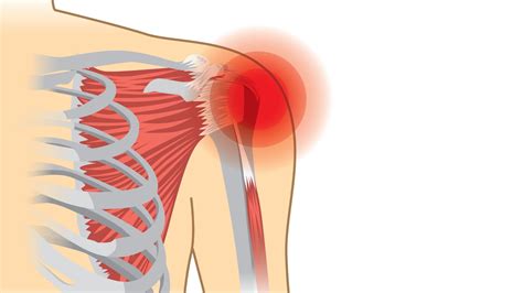 Rotator Cuff Tear Symptoms, Causes and Treatment