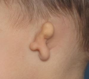 Microtia – Beverly Hills, CA – Reinisch Plastic Surgery