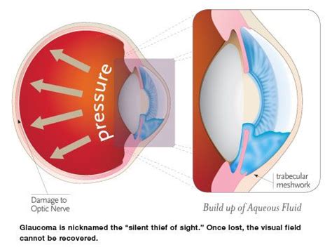 Intraocular pressure (IOP) - Eye Pressure