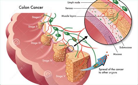 Colorectal Cancer - Introduction, Etiology and Pathology, Symptoms ...