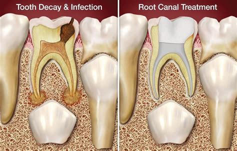 Burnaby Endodontics, Root Canals: 4800 Kingsway #359