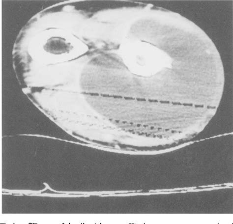 Figure 1 from Ganglion Cyst Communicating with the Elbow Joint Presenting as a Distal Forearm ...