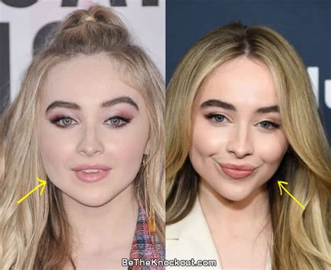 Sabrina Carpenter Surgery