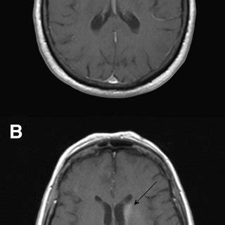 (PDF) A Case of Hemichorea-Hemiballismus Due to Nonketotic Hyperglycemia