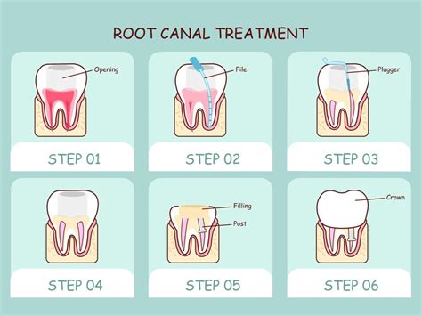 How long is root canal recovery?