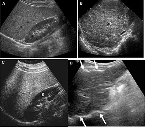 Heterogeneous Liver on Research Ultrasound Identifies Children with Cystic Fibrosis at High Risk ...