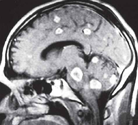 Radiologic Miliary Patterns of Cerebral Tuberculosis | Infectious ...