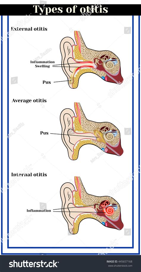 Tipos de otitis: otitis externa, media: vector de stock (libre de regalías) 445657168 | Shutterstock