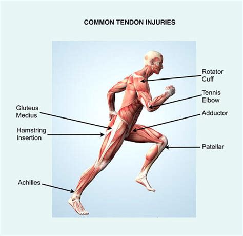 Chronic Tendon Injury PRP treatment in Kochi | Tendinosis Therapy Kerala