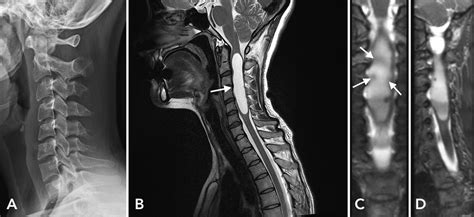 Cureus | Multicentric Spinal Pilocytic Astrocytoma Presenting with ...