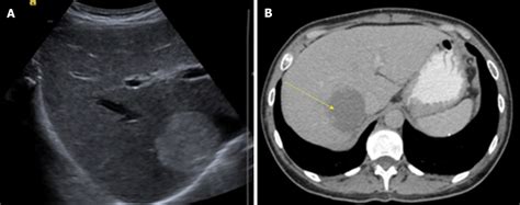 Hepatic hemangioma: What internists need to know