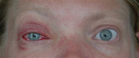 Adenoviral Conjunctivitis