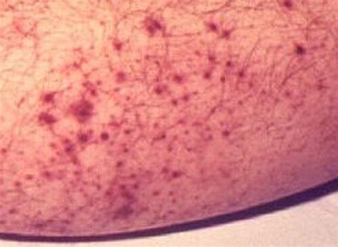 Petechiae - Pictures, Causes, Symptoms, Diagnosis and Treatment